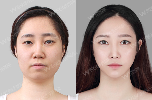韩国原辰整形外科医院双眼皮手术对比案例
