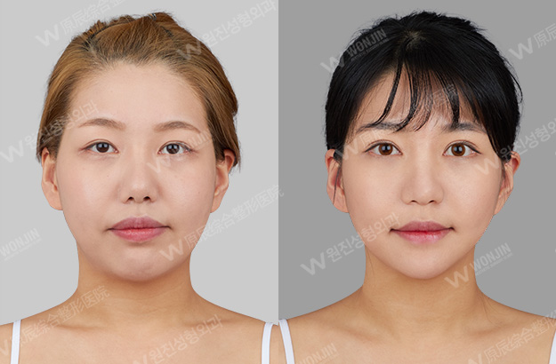 韩国原辰整形外科医院双眼皮手术对比案例