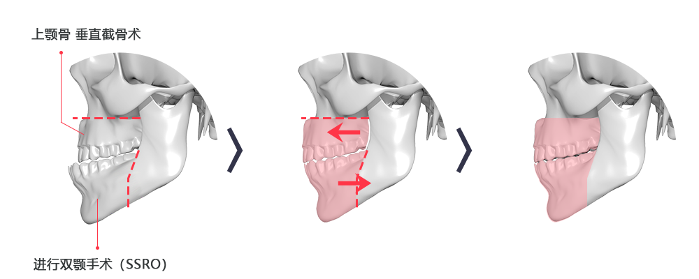위 턱과 아래 턱 모두 비대칭이 있는 경우 (상악골 수평절단술 + SSRO)