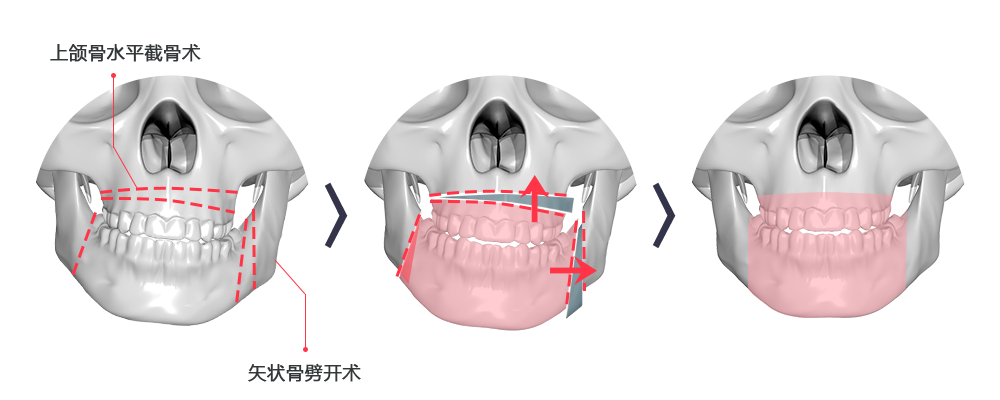 위 턱뼈의 비대칭이 심할 경우 (상악골 수평절단술 + SSRO)