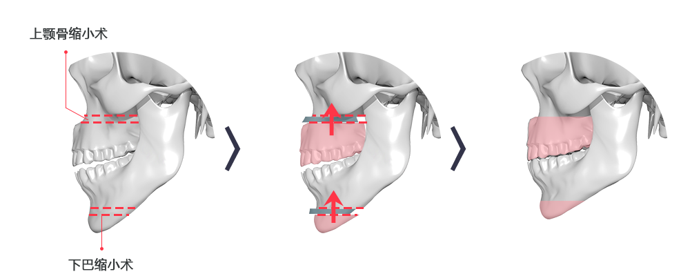 중안면부가 길고 주걱턱이 함께 있는 경우 상악골 축소술 + IVRO 혹은 턱 끝 축소술