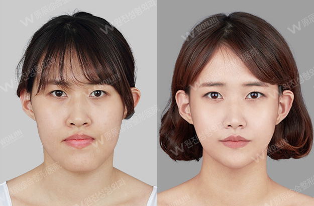 长脸整形案例-韩国原辰整形外科医院
