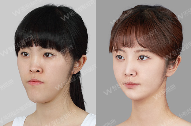 面部不对称整形案例-韩国原辰整形外科医院