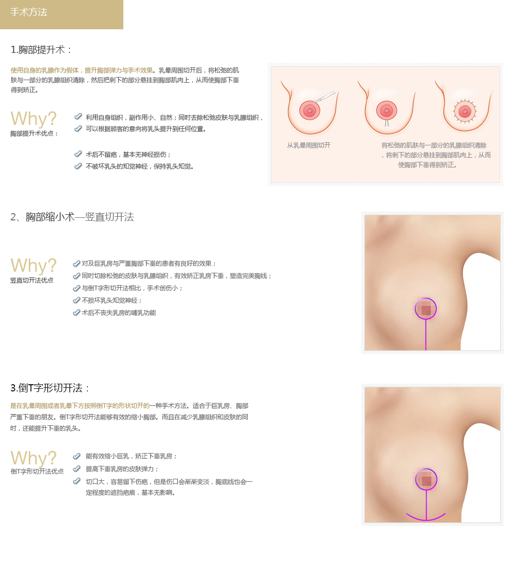 韩国胸部下垂矫正的费用