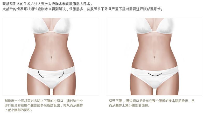 韩国原辰整形外科腹部吸脂