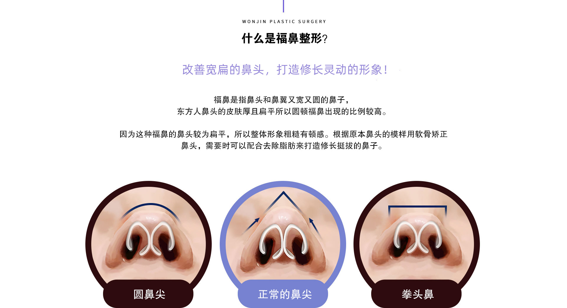 鼻孔縁を下げる鼻尖縮小術 SAD法 | 鼻の症例集 銀座すみれの花形成クリニック