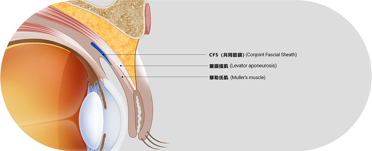 WJ原辰CFS（共同筋膜）眼型矫正