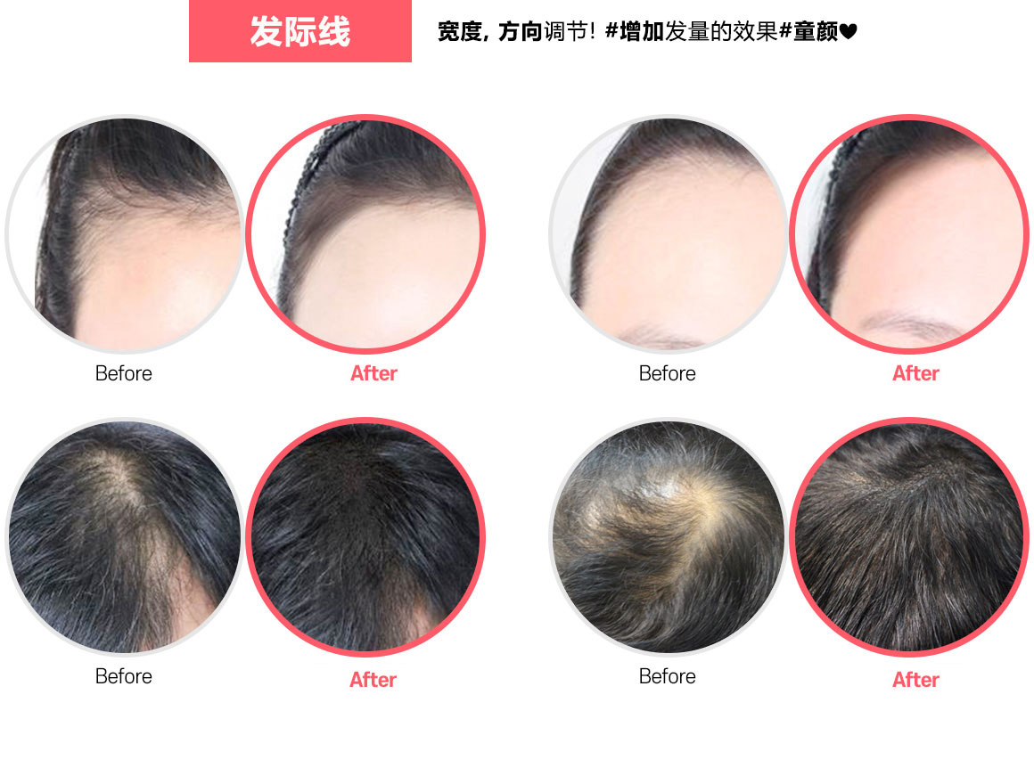 헤어라인 반영구 전후사진