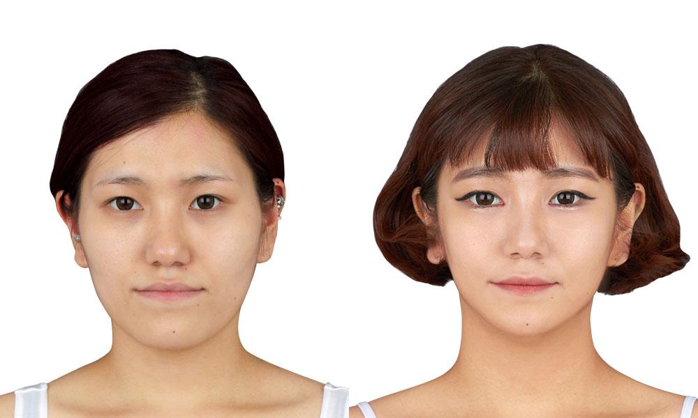 주걱턱 양악수술 전후사진 - 정면