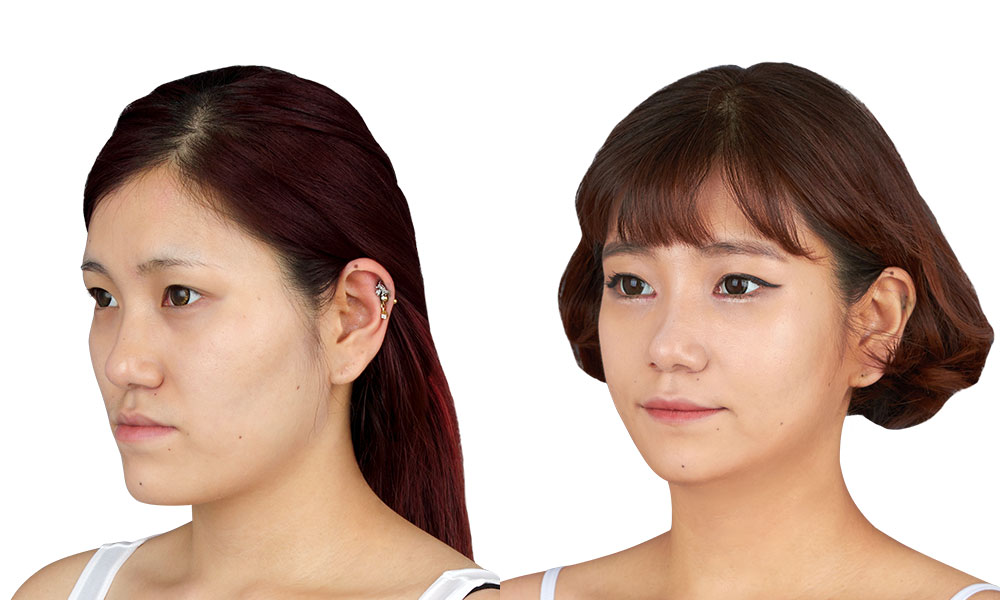 20대 여 주걱턱 수술 전후 사진 - 45도