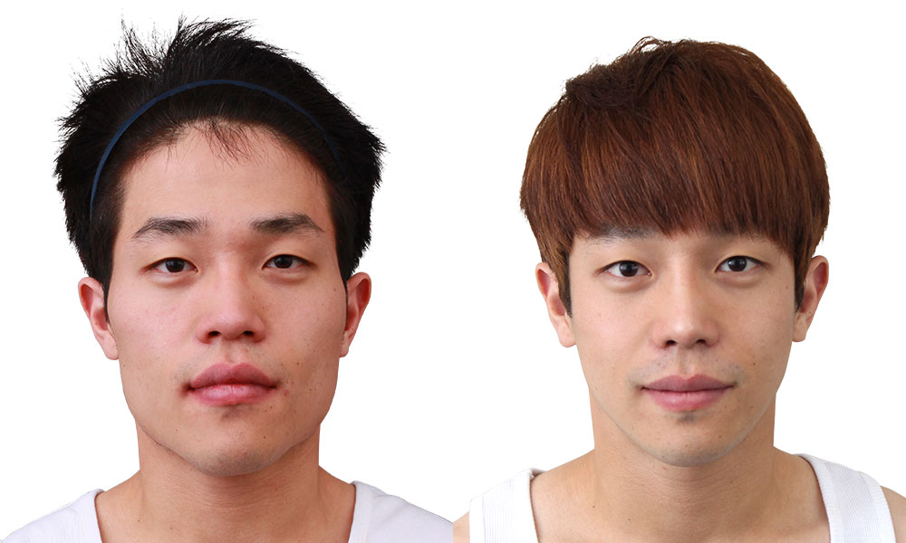돌출입 양악수술 전후사진 - 정면