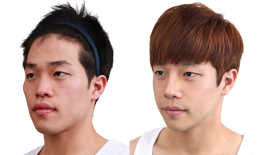 20대 남 돌출입 수술 전후 사진 - 45도
