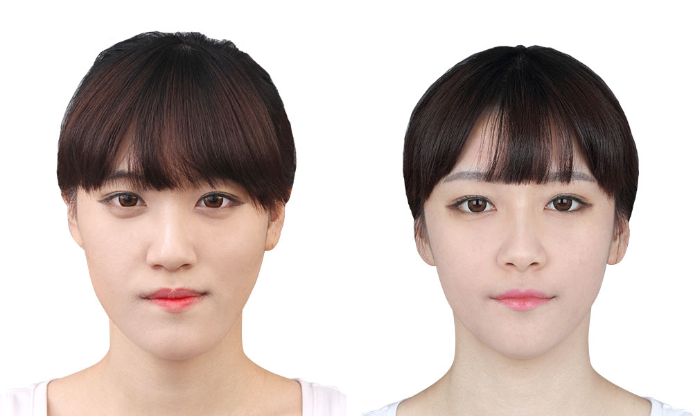안면비대칭 양악수술 전후사진 - 정면