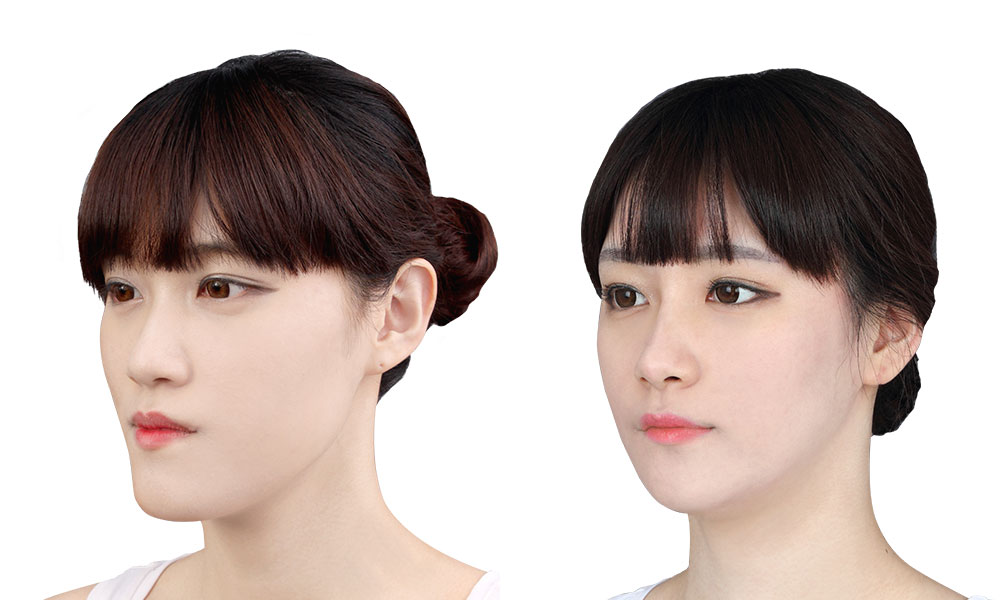 20대 여 안면비대칭 수술 전후 사진 - 45도