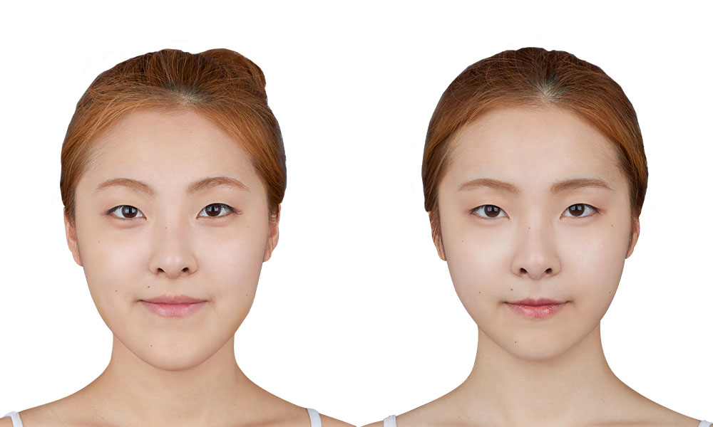 긴얼굴 양악수술 전후사진 - 정면