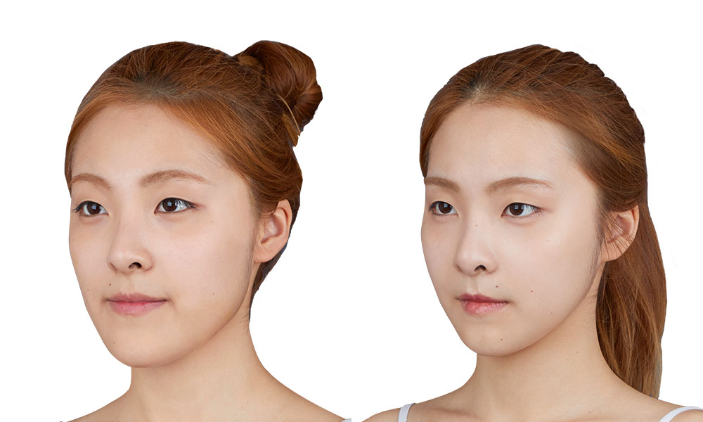 20대 여 긴얼굴 수술 전후 사진 - 45도