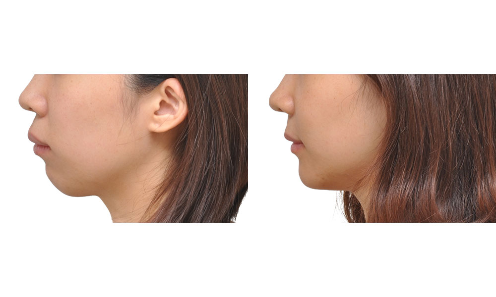 30대 여 무턱 수술 전후 사진 - 옆면