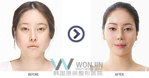 做下颌角手术韩国哪家医院最好,下颌角手