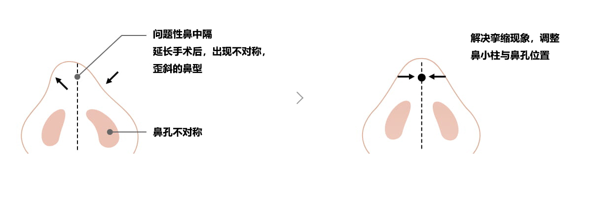 手术后出现歪鼻的情况